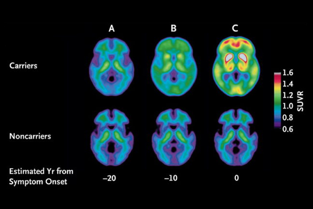 Clinical and Biomarker Changes in Dominantly Inherited Alzheimer’s Disease