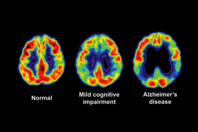 Eli Lilly’s Experimental Alzheimer’s Drug Fails in Large Trial